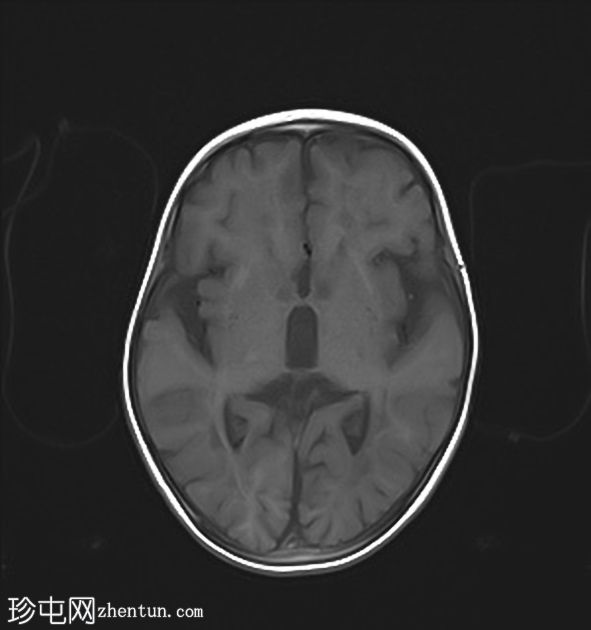 消失性白质病