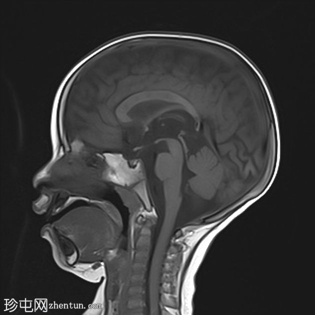 消失性白质病