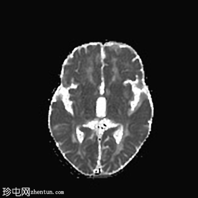 消失性白质病