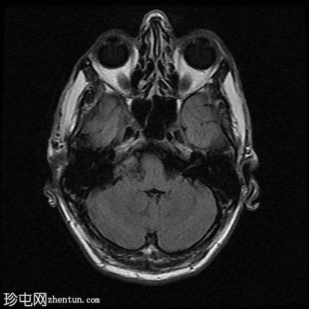 表皮样囊肿-桥小脑角