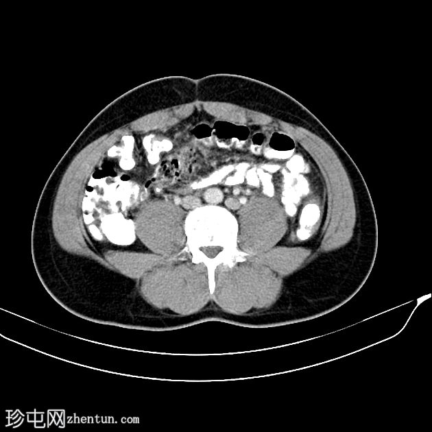 持续Müllerian导管综合征，双侧隐睾，右侧睾丸扭转肿瘤