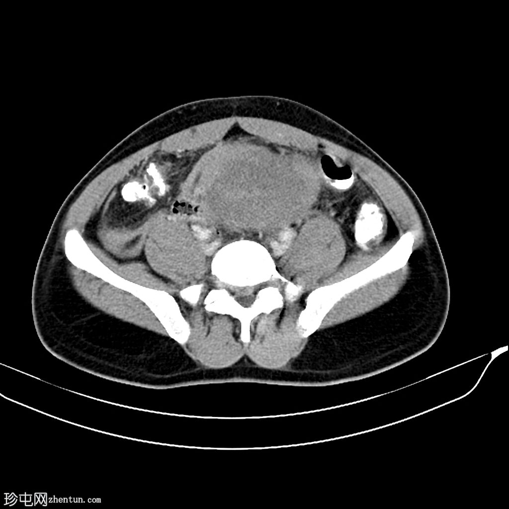 持续Müllerian导管综合征，双侧隐睾，右侧睾丸扭转肿瘤