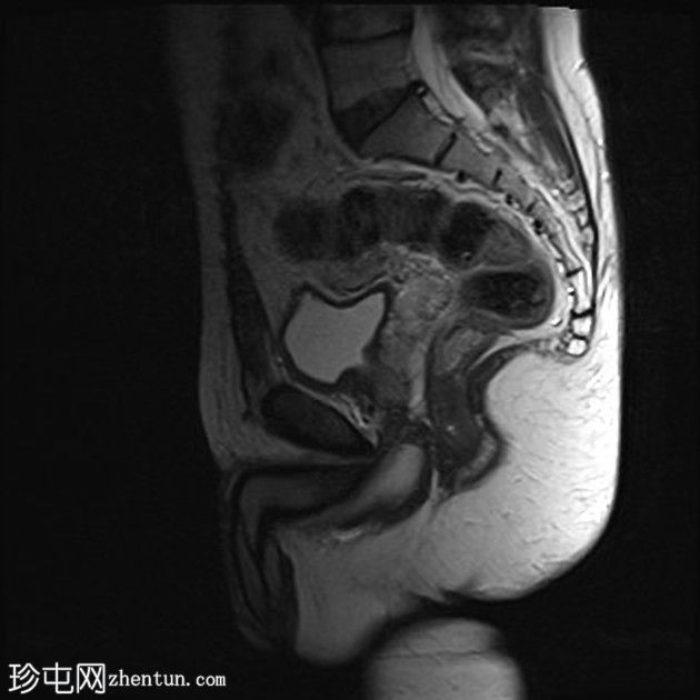 持续Müllerian导管综合征，双侧隐睾，右侧睾丸扭转肿瘤