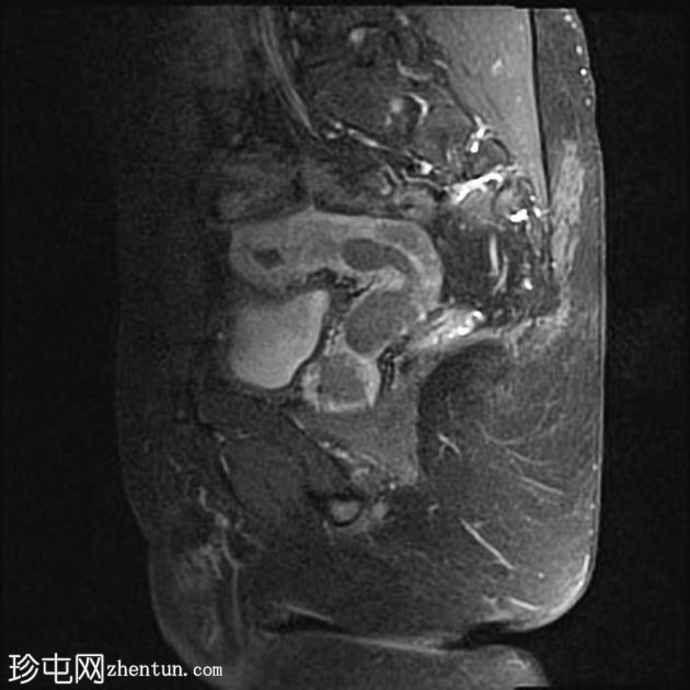 持续Müllerian导管综合征，双侧隐睾，右侧睾丸扭转肿瘤