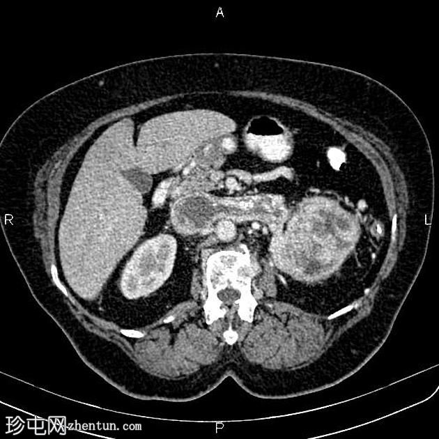 肾细胞癌延伸至肾静脉和下腔静脉