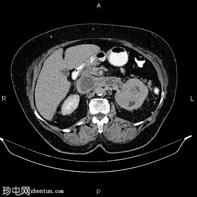 肾细胞癌延伸至肾静脉和下腔静脉