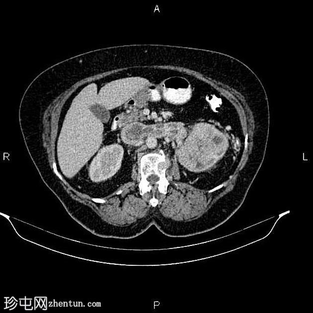 肾细胞癌延伸至肾静脉和下腔静脉