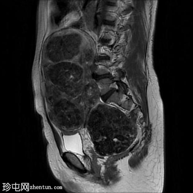 多发性子宫平滑肌瘤