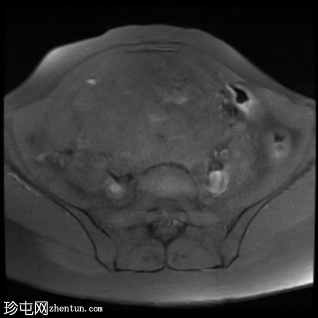 多发性子宫平滑肌瘤