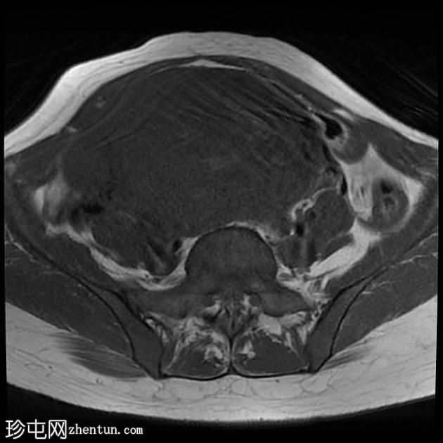 多发性子宫平滑肌瘤