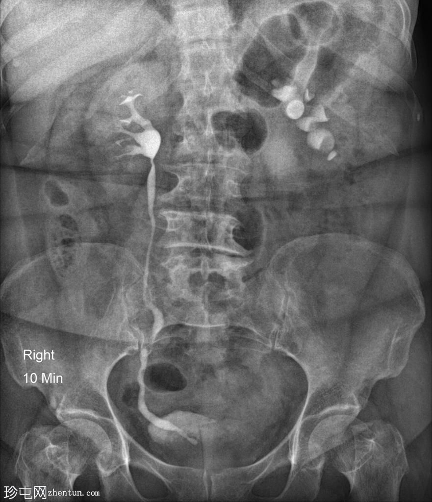 左肾盂输尿管连接处梗阻