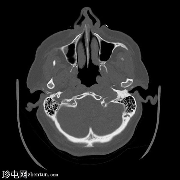 依格尔综合征(Eagle syndrome)