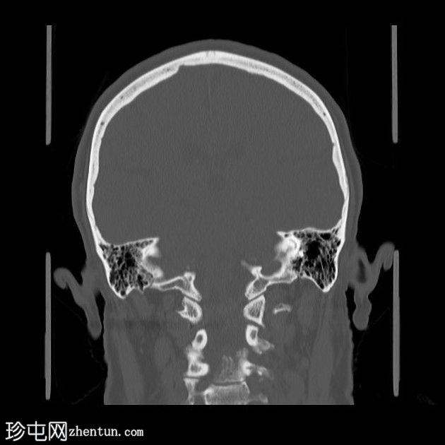 依格尔综合征(Eagle syndrome)