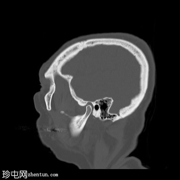 依格尔综合征(Eagle syndrome)