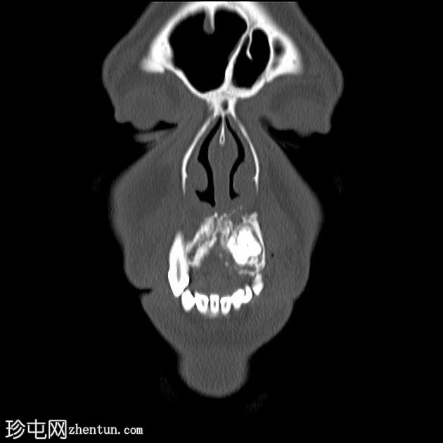 牙源性钙化上皮瘤