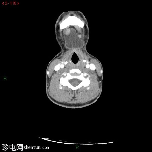 甲状舌管囊肿