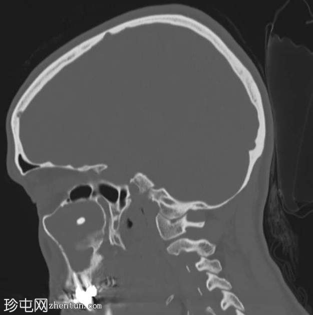 上颌窦异位牙