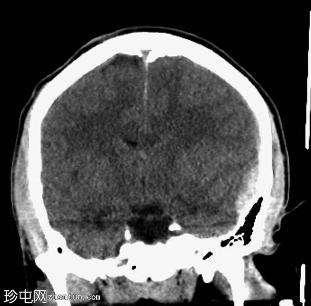 中枢神经系统损伤导致呼吸衰竭