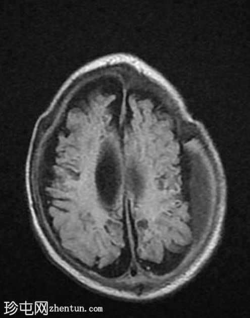 多囊胞性脑软化症（multicystic encephalomalacia,MCE）