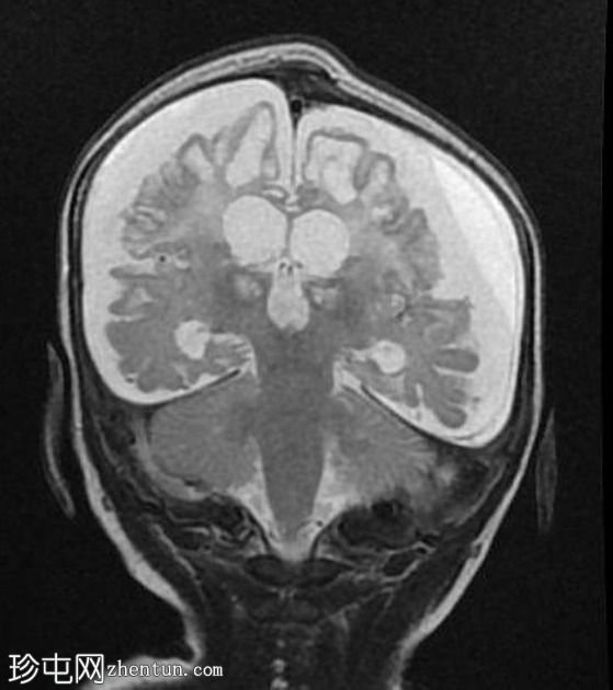 多囊胞性脑软化症（multicystic encephalomalacia,MCE）