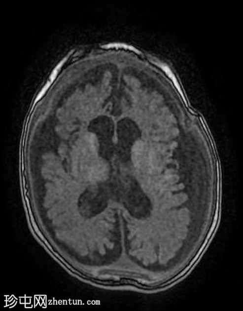 多囊胞性脑软化症（multicystic encephalomalacia,MCE）