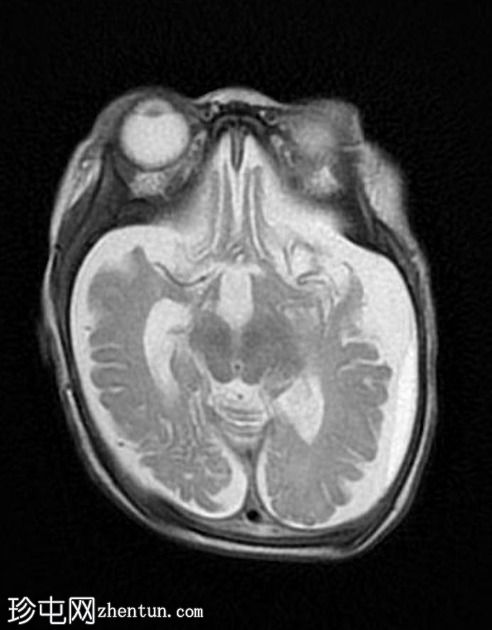 多囊胞性脑软化症（multicystic encephalomalacia,MCE）