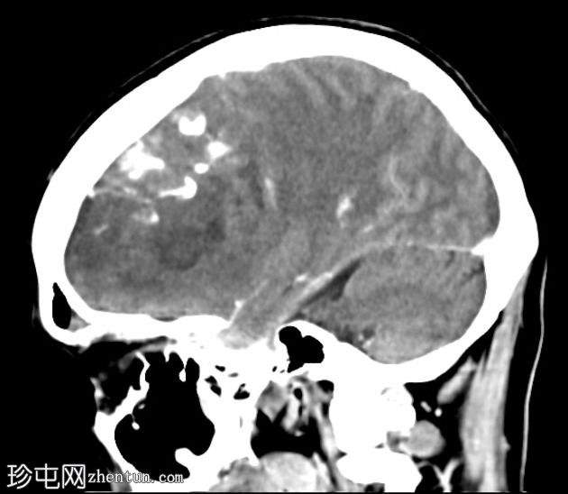 少突神经胶质瘤