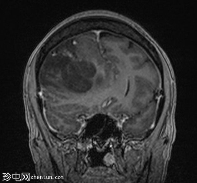 少突神经胶质瘤