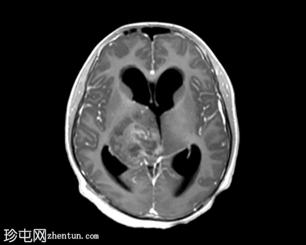 双侧丘脑间变性神经节细胞胶质瘤
