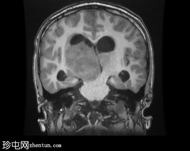 双侧丘脑间变性神经节细胞胶质瘤