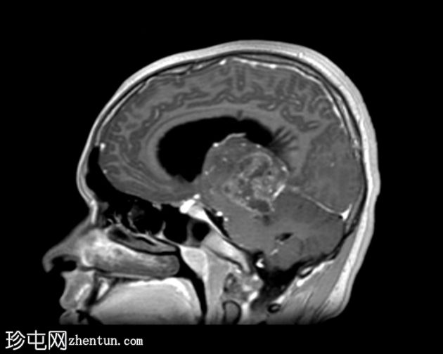 双侧丘脑间变性神经节细胞胶质瘤