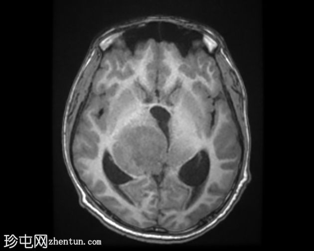 双侧丘脑间变性神经节细胞胶质瘤