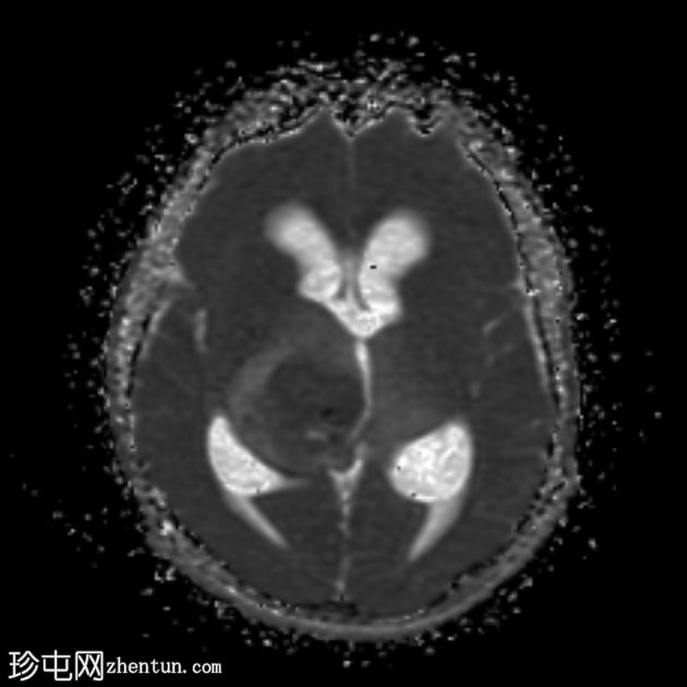 双侧丘脑间变性神经节细胞胶质瘤