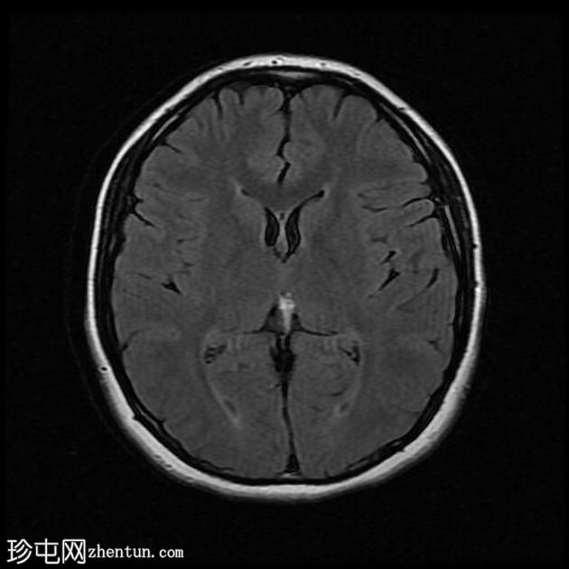 曲线型胼胝体周脂肪瘤