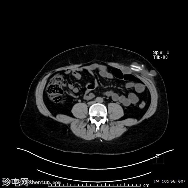 腰腹膜分流术定位不良继发腹壁假性囊肿