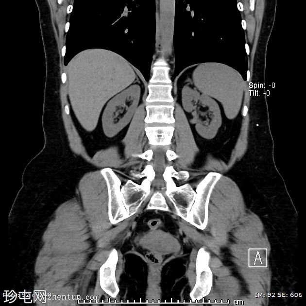 腰腹膜分流术定位不良继发腹壁假性囊肿