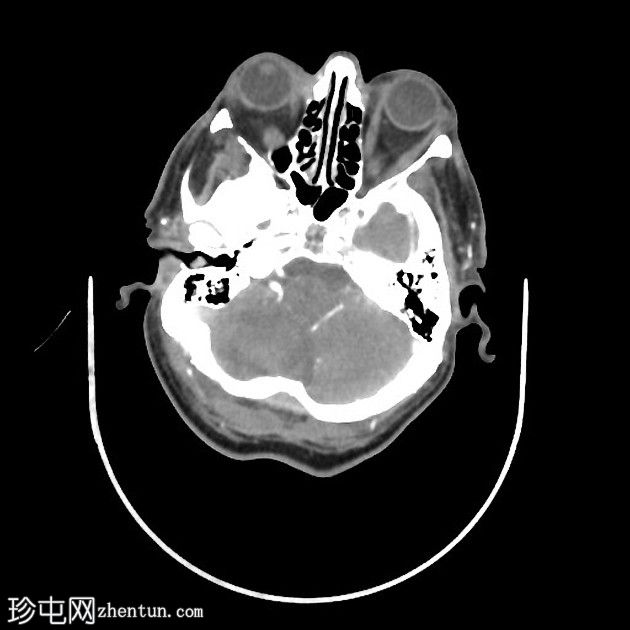 亚急性小脑后下动脉梗死