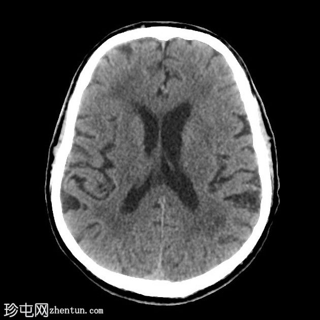 亚急性小脑后下动脉梗死