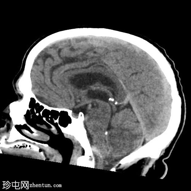 亚急性小脑后下动脉梗死