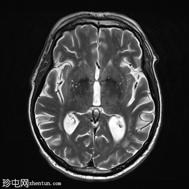 亚急性小脑后下动脉梗死