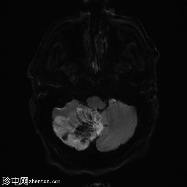 亚急性小脑后下动脉梗死