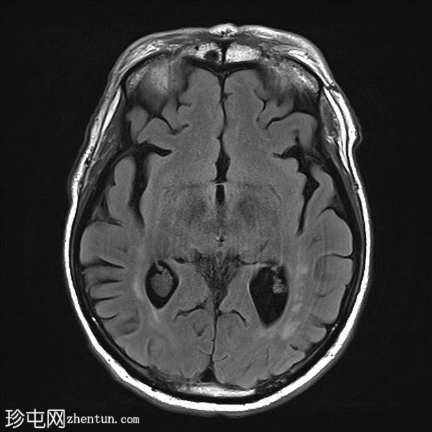 亚急性小脑后下动脉梗死