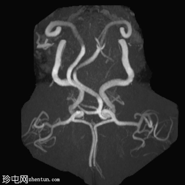 亚急性小脑后下动脉梗死