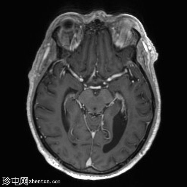 亚急性小脑后下动脉梗死