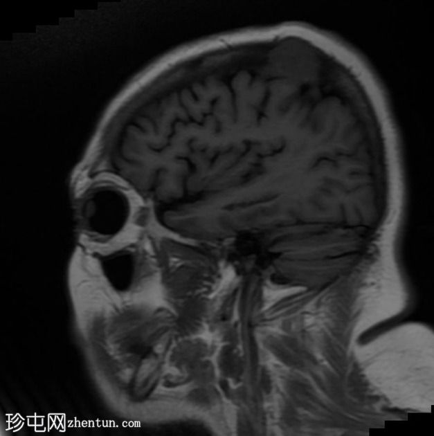 肺腺癌单发性淋巴结内转移