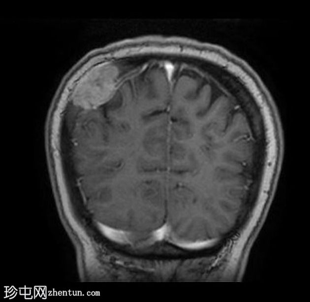 肺腺癌单发性淋巴结内转移