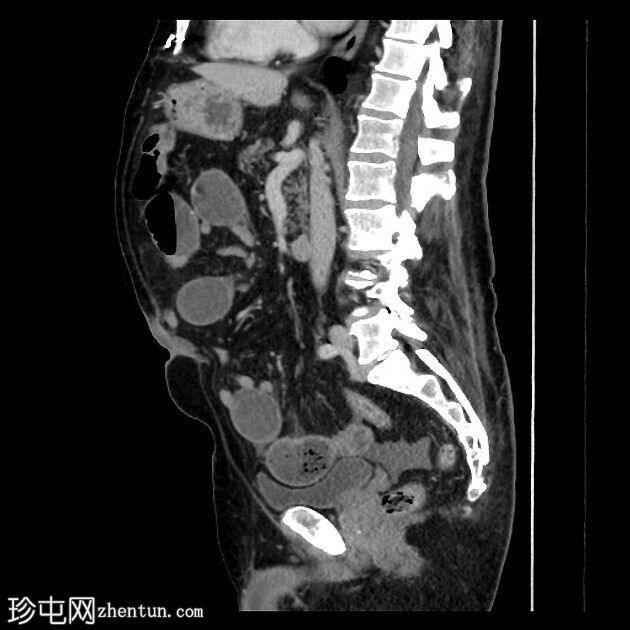 恶性小肠梗阻-转移