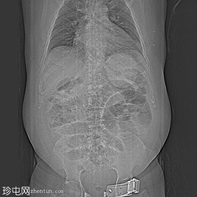 恶性小肠梗阻-类癌/神经内分泌肿瘤