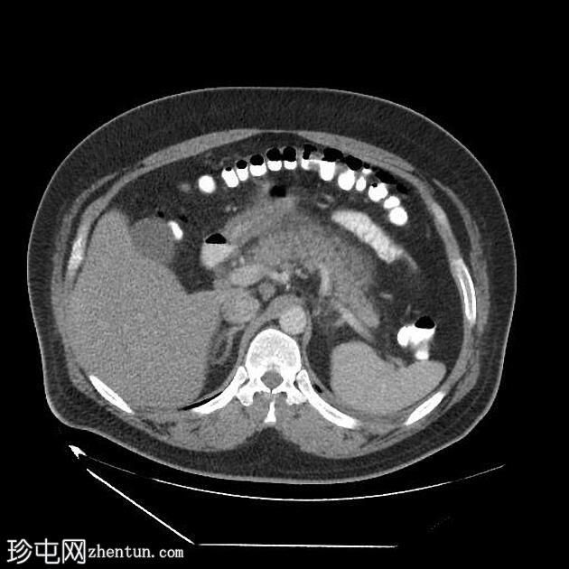 急性胰腺炎