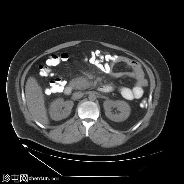 急性胰腺炎